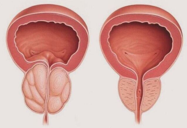 tratamentul eficient al prostatitei și erecției